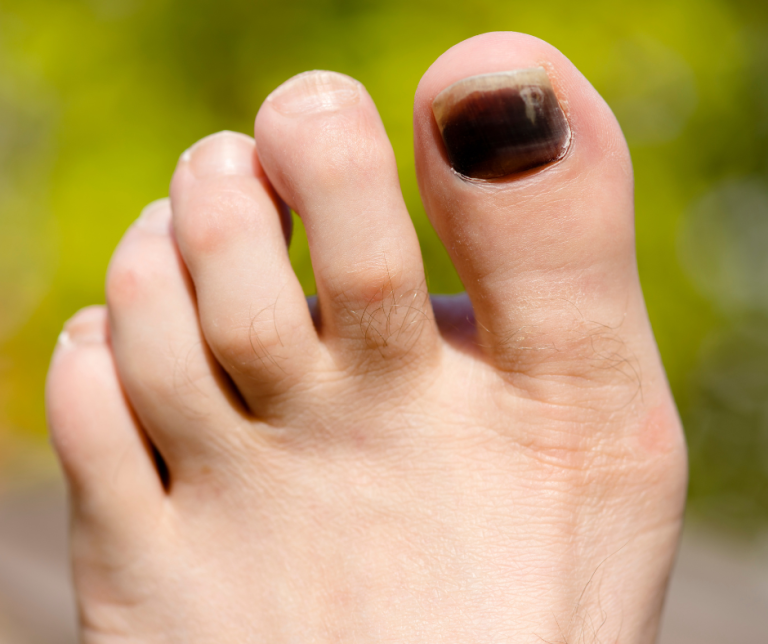 Why is Your Toenail Black?