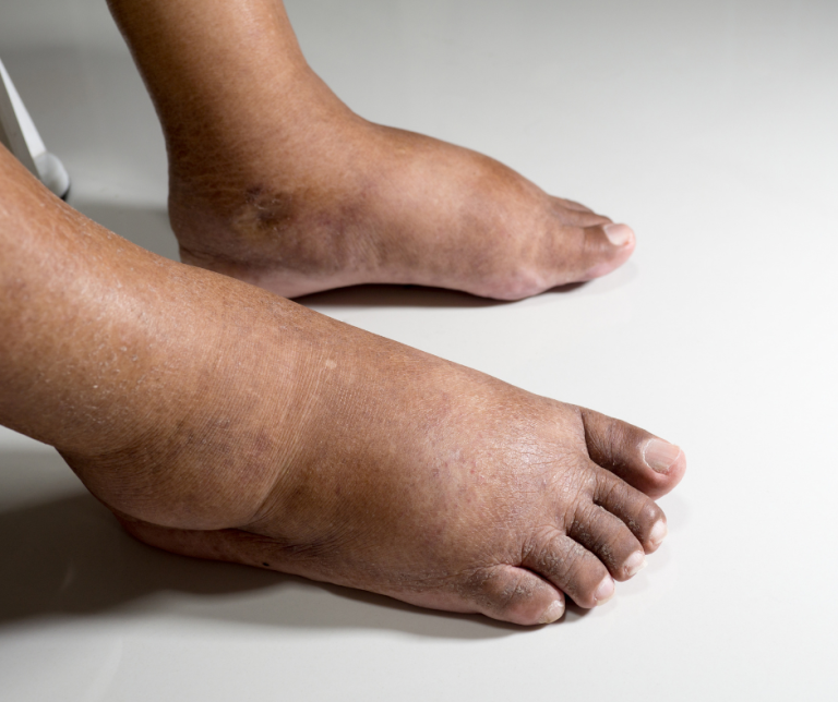 swollen feet