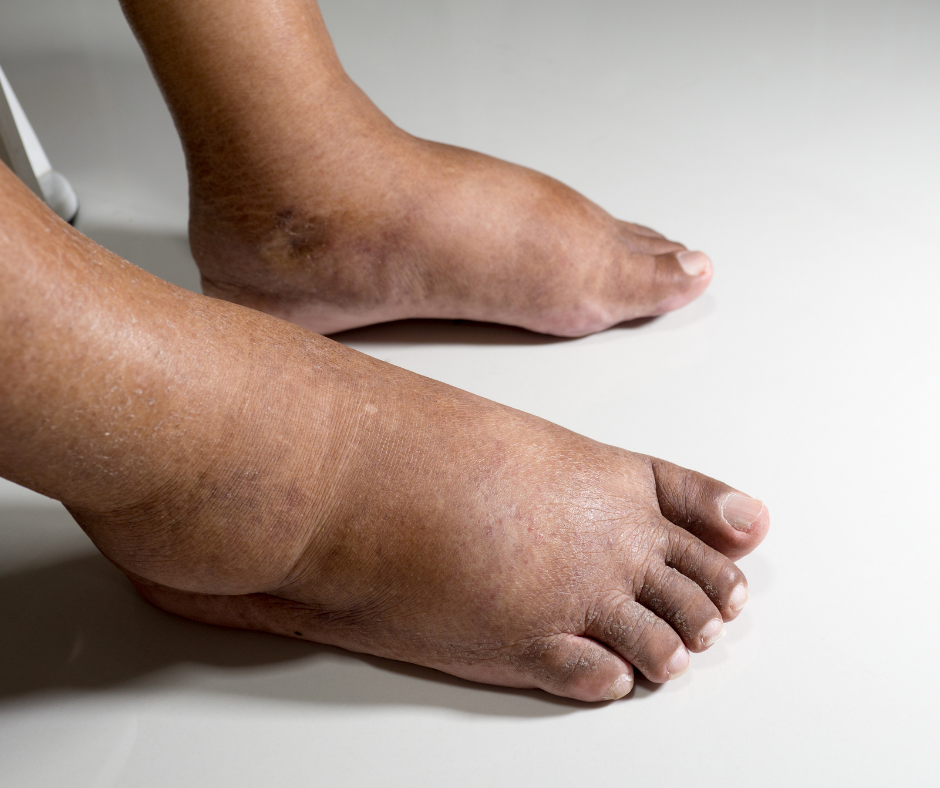 swollen feet